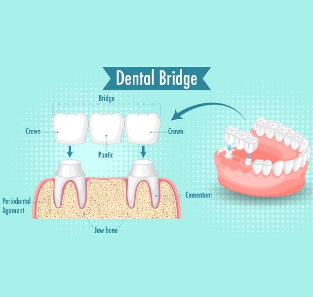 dental bridges image