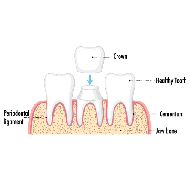 dental crowns image