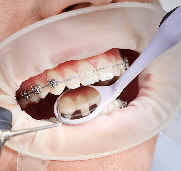 preparation for orthodontic treatment small image