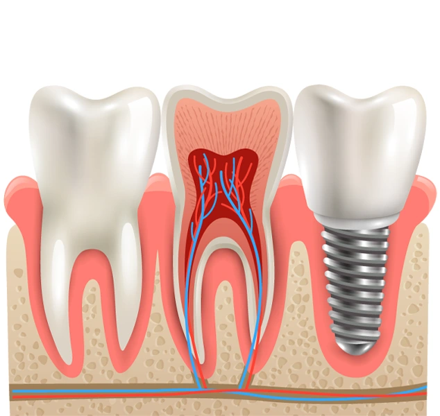 your perfect smile with dental implants image